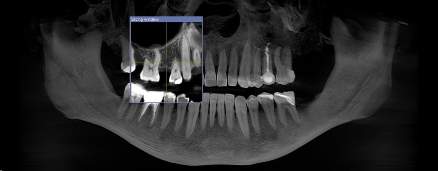 Fáze implantace zubů
