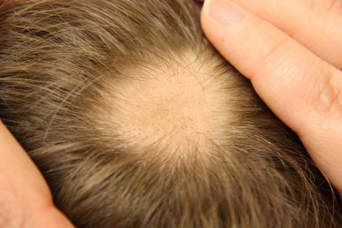 Alopecie - vypadávání vlasů